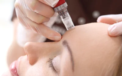 Alivia Acupuncture Clinic is now offering Holistic Microneedling.