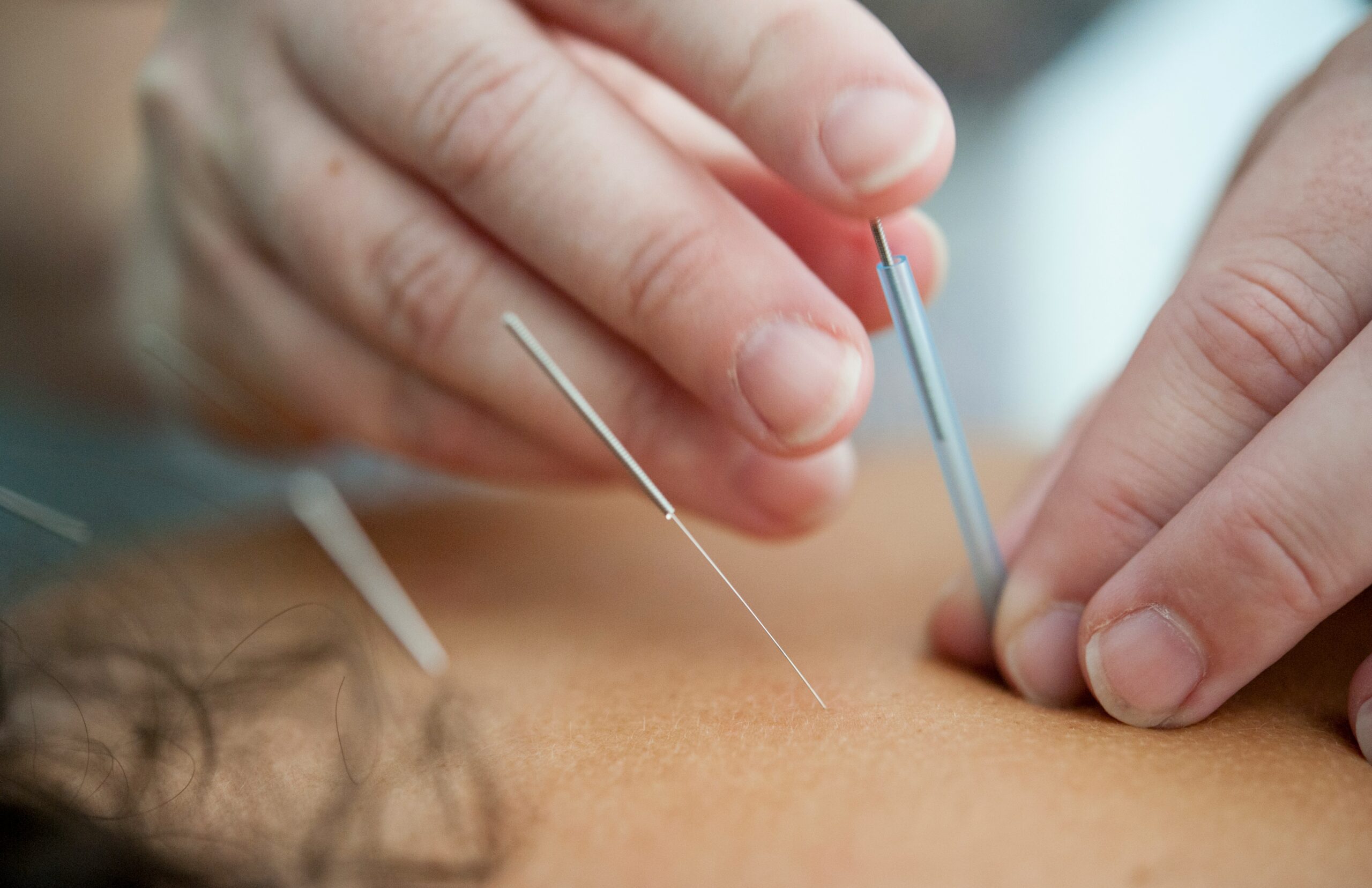 Is Acupuncture Real or a Placebo?