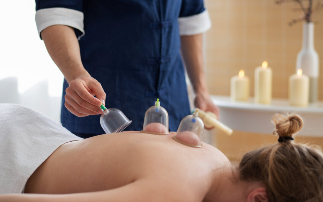 Common Questions About Cupping for Pain and Musculoskeletal Conditions