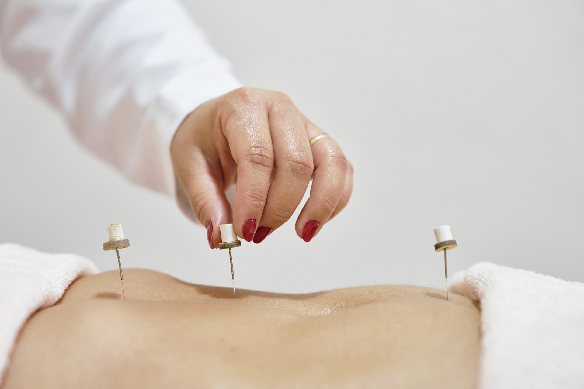 Targeted Acupuncture