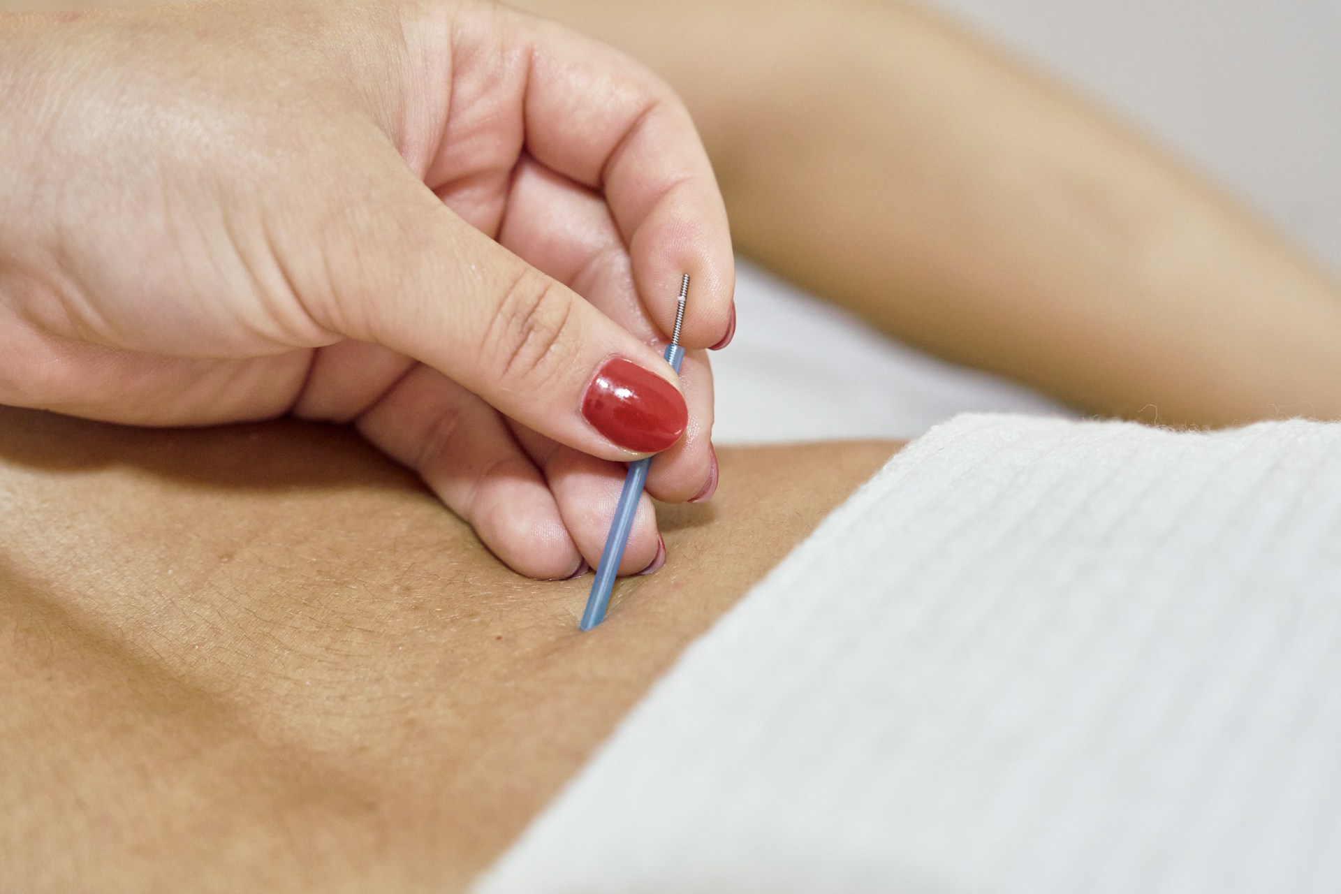 acupuncture for back pain acupuncture for back pain