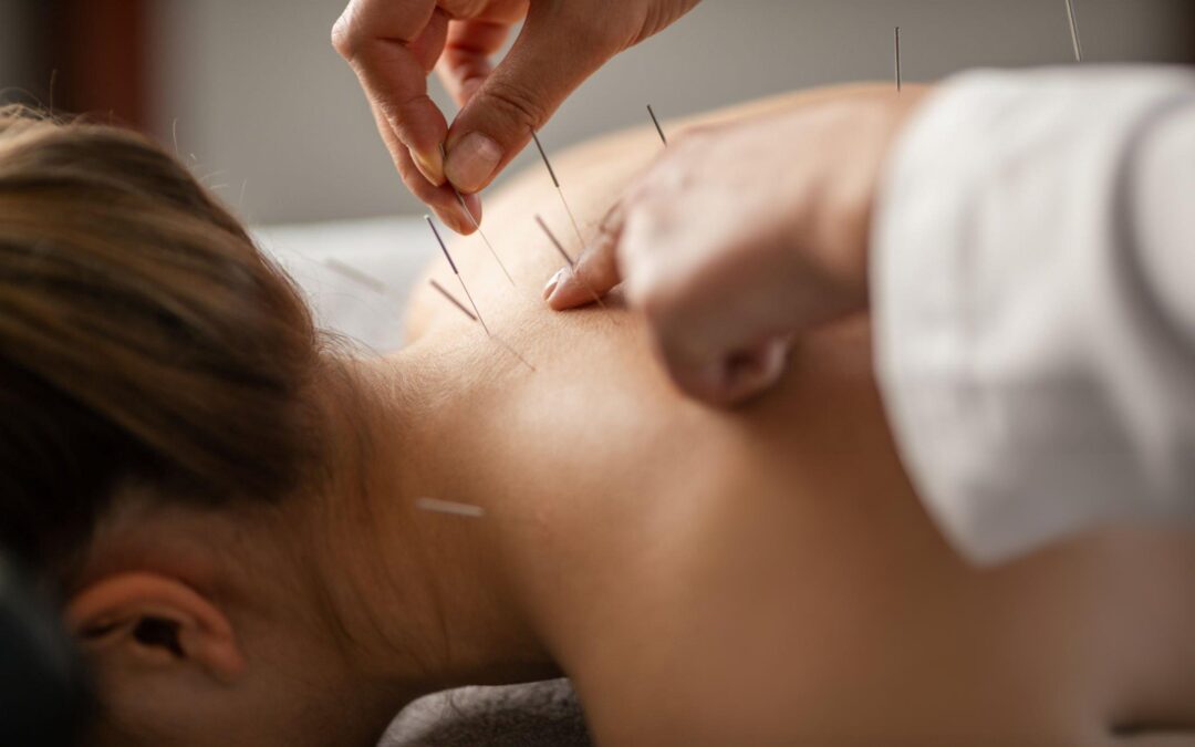 What to Expect from Acupuncture Services in Scottsdale