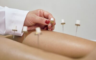 Why Acupuncture for Anxiety Near Me May Help During The Holidays