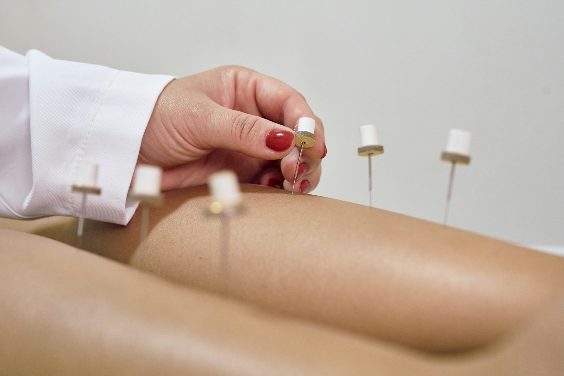 Acupuncture Acupuncture