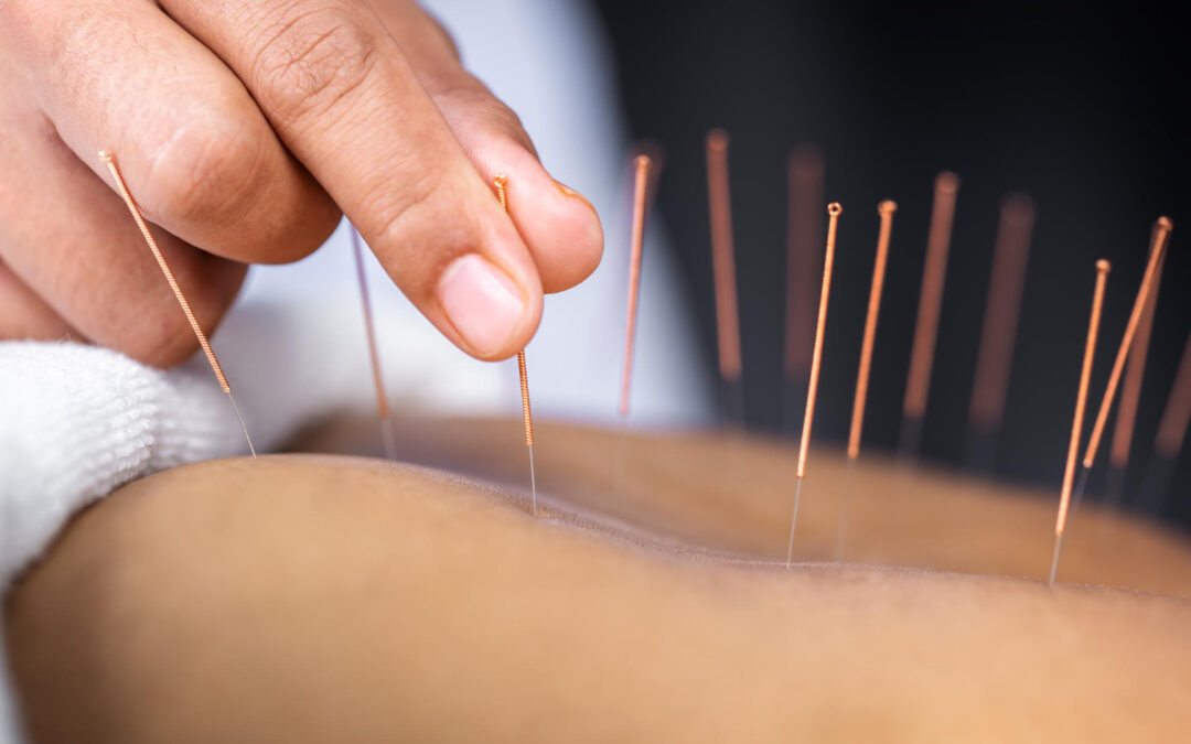 Ways Acupuncture May Support Sciatic Comfort