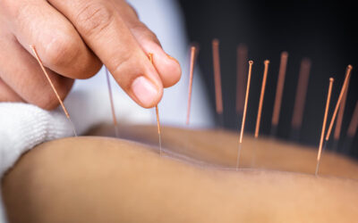 Ways Acupuncture May Support Sciatic Comfort