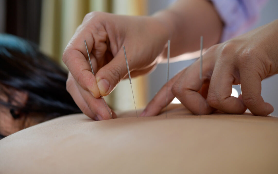 Guide to Using Acupuncture for Improved Fertility Health
