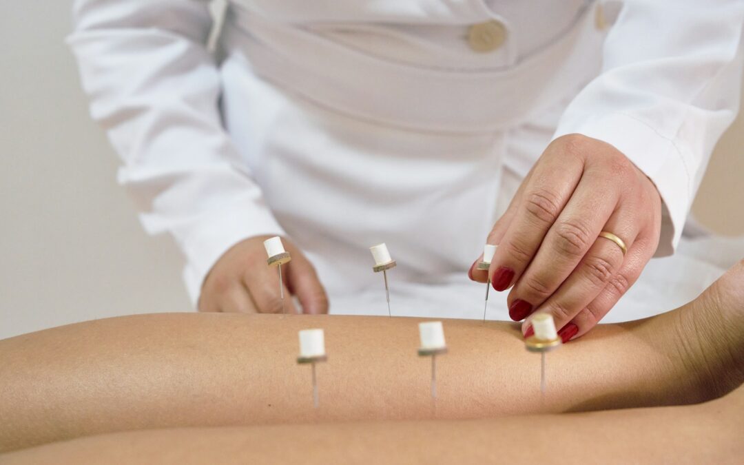 acupuncture