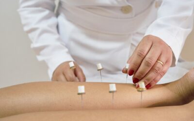Why Consider Acupuncture for Reducing Menopausal Discomfort?