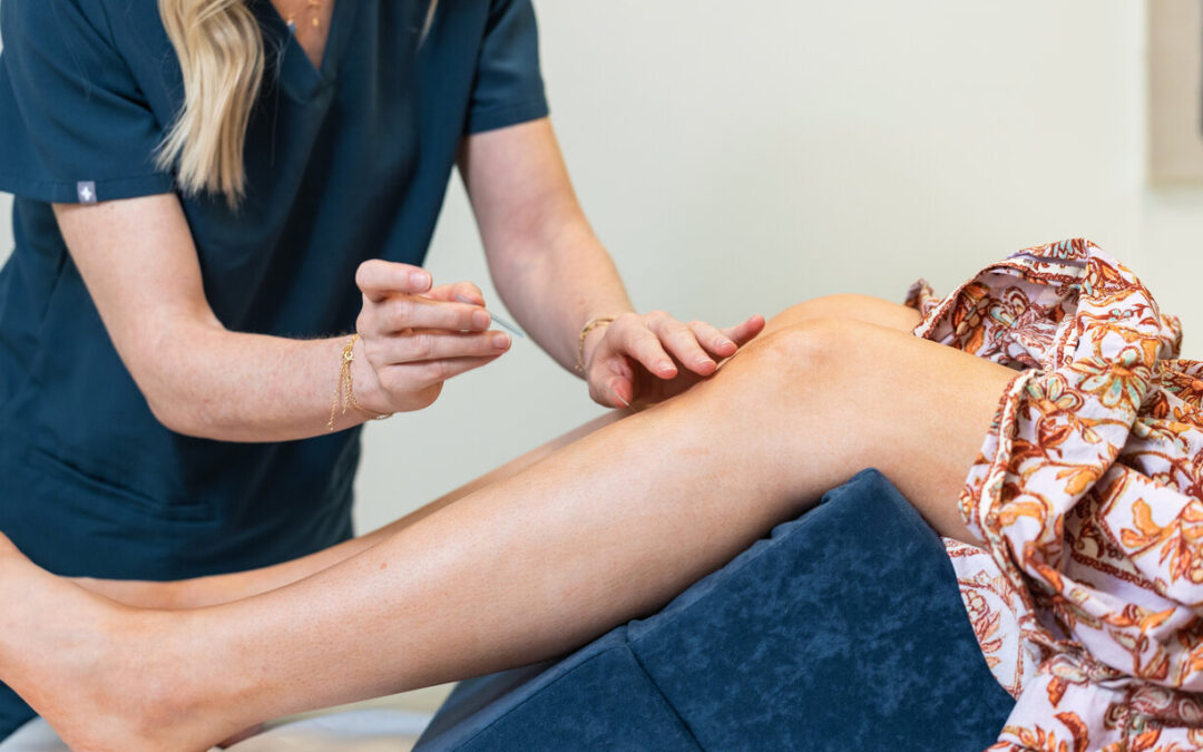 acupuncture