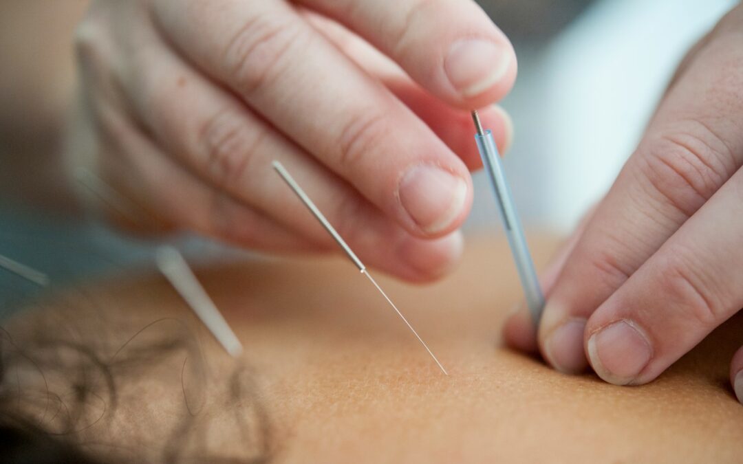 acupuncture