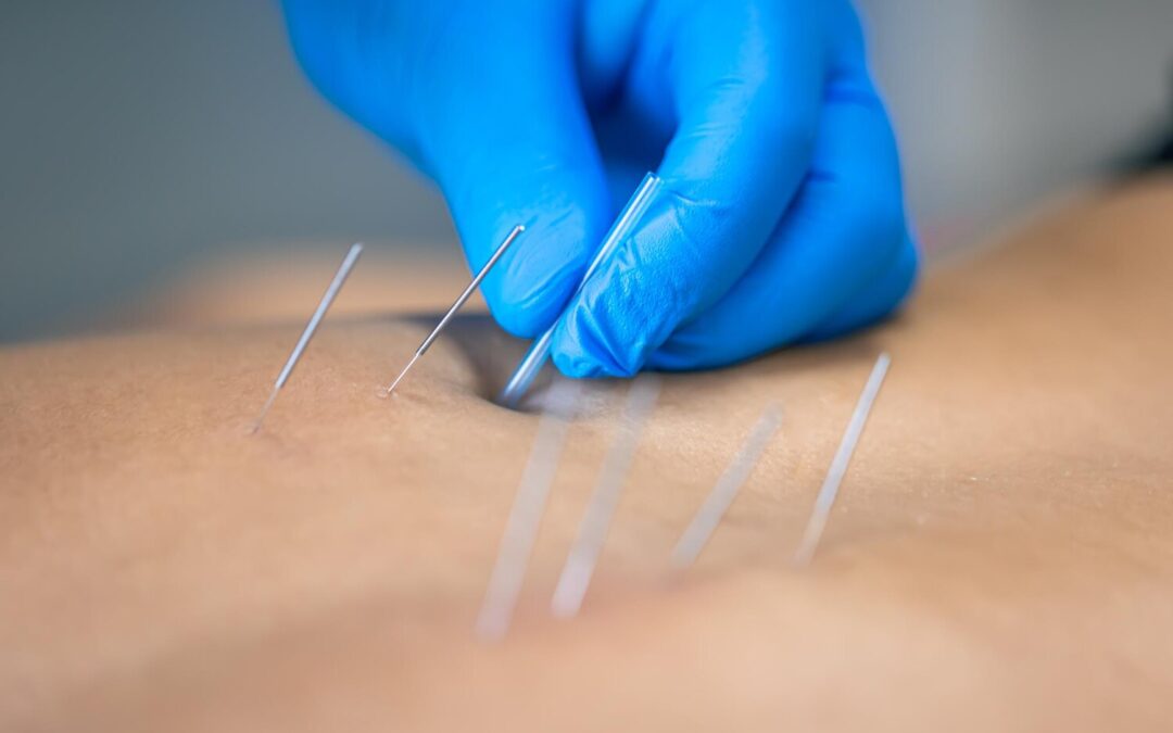 Acupuncture