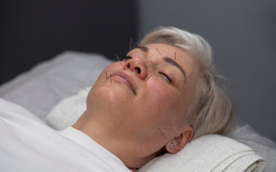 Stress Relief Acupuncture
