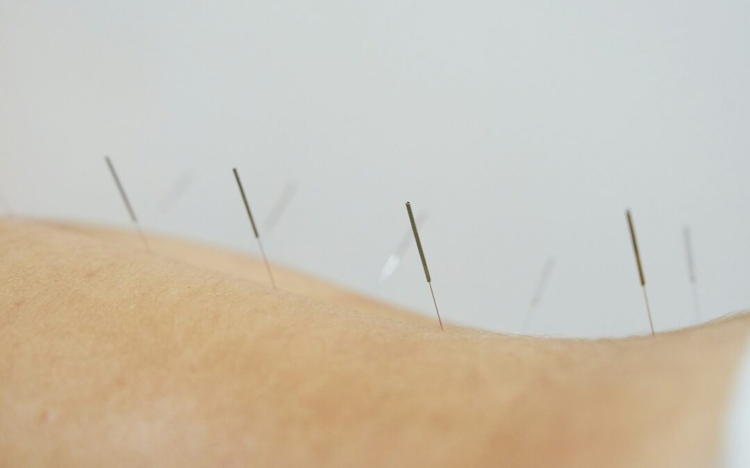 acupuncture